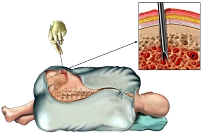 Биопсия костного мозга при гипопластической анемии
